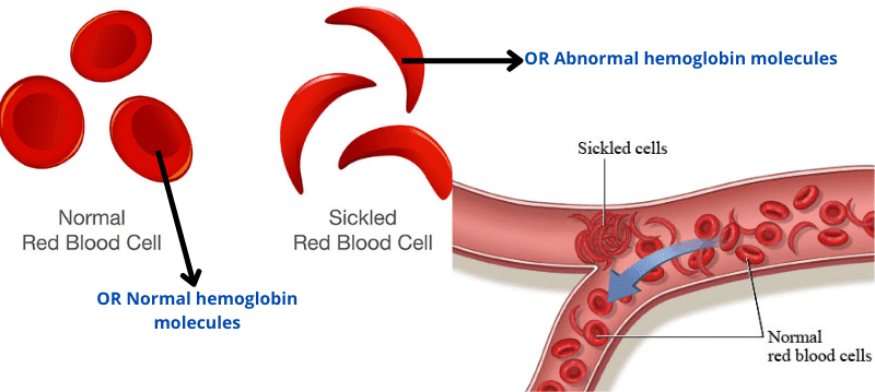 Sickle Cell Anemia: Causalities, Signs, Therapy, and Prevention