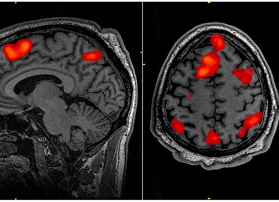 Leigh Syndrome: Reasons, Signs, Diagnosis, and Cure